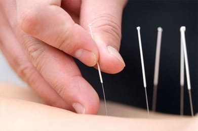 Acupuncture therapy