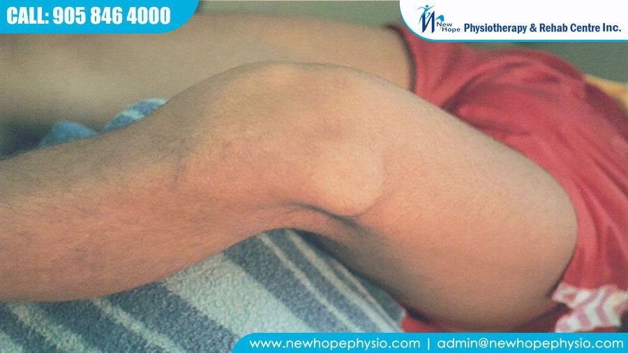 Patellar Dislocation