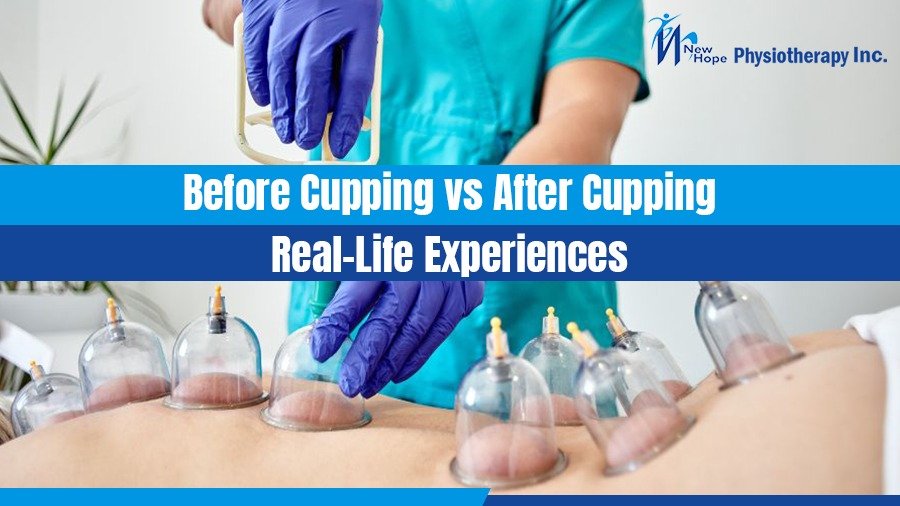 Before Cupping vs. After Cupping