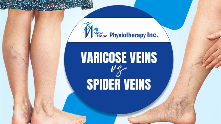 Varicose Veins vs. Spider Veins