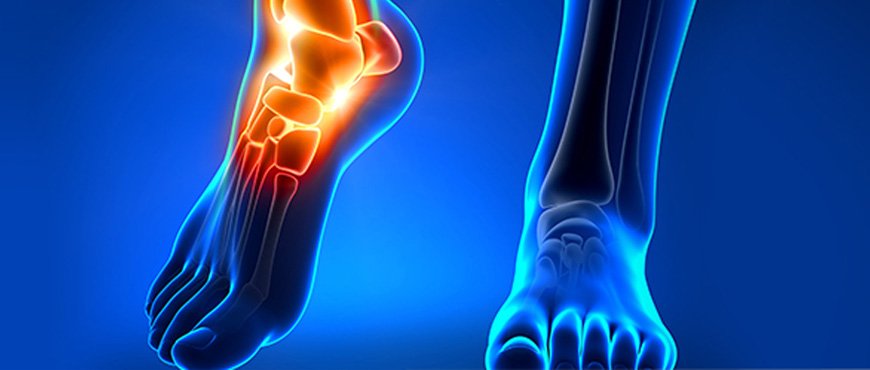 Chronic Ankle instability